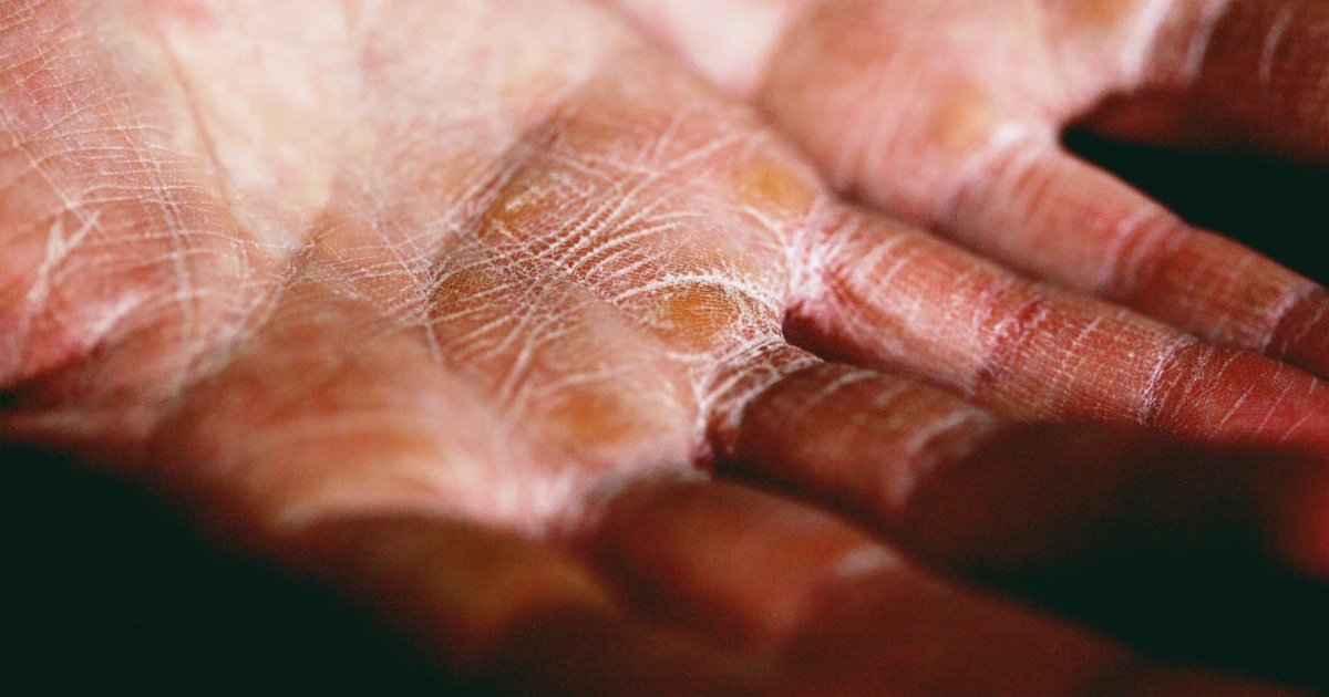 Eczema hand